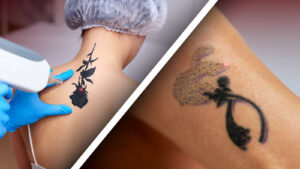 What is Laser Tattoo Removal?